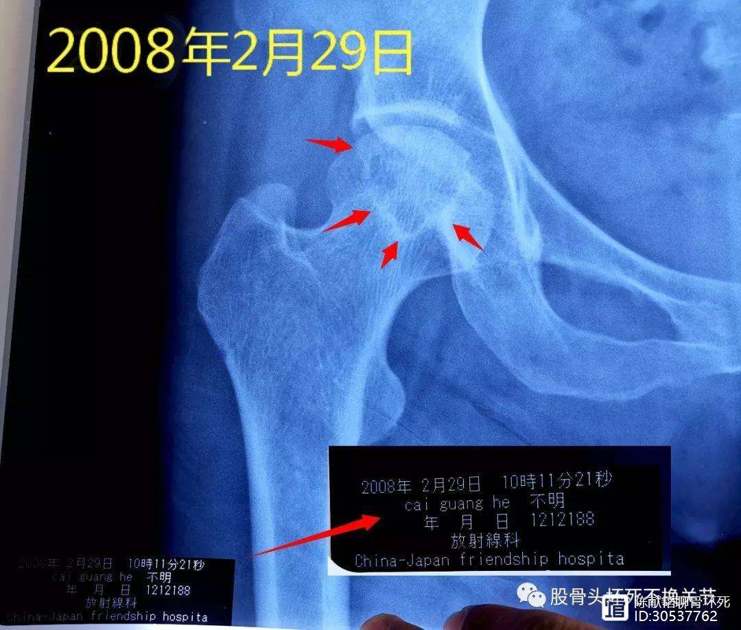 平凉人工骨头医保报销多少(人工骨头医保报销多少比例)