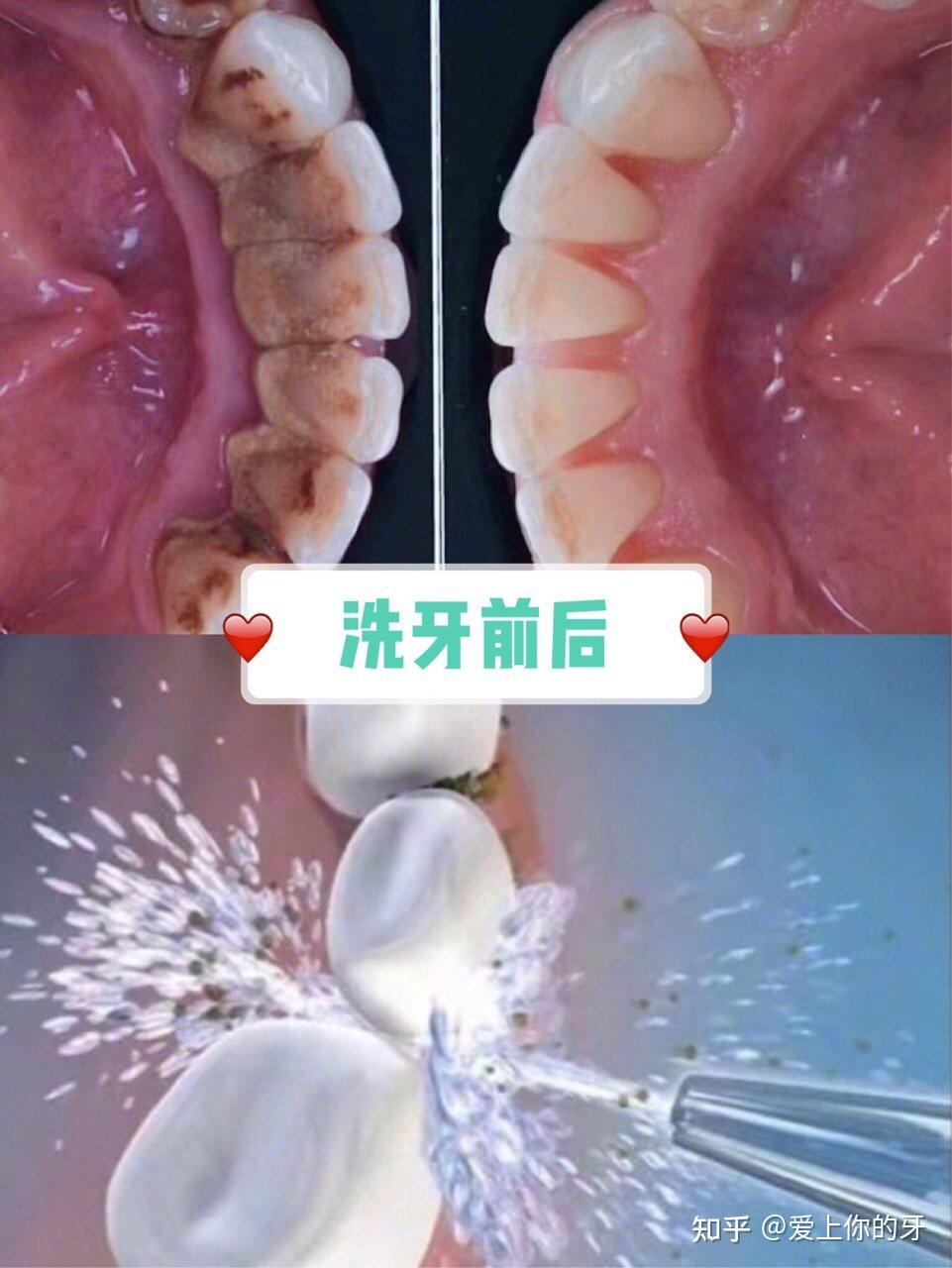 平凉洗牙可以用医保吗(洗牙可以用医保吗,报销比例多少)